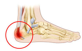 heel pain in teenage athletes